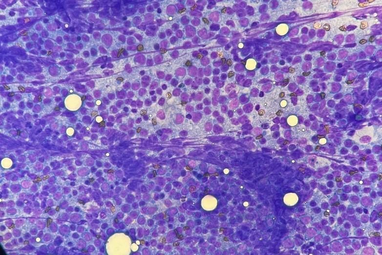 Parte 4: Tumores de células redondas